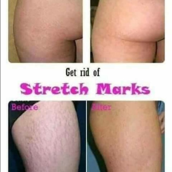 Scarless Cream Acne Stretch Mark Pimple Marks - Picture 8 of 8